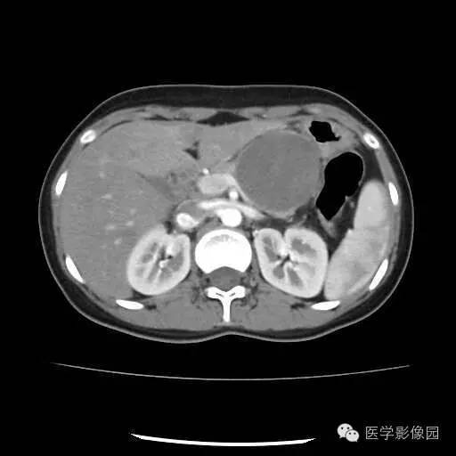 【病例】胰腺实性假乳头状瘤1例CT影像表现 【病例】胰腺实性假乳头状瘤1例CT影像表现