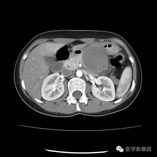 【病例】胰腺实性假乳头状瘤1例CT影像表现 【病例】胰腺实性假乳头状瘤1例CT影像表现