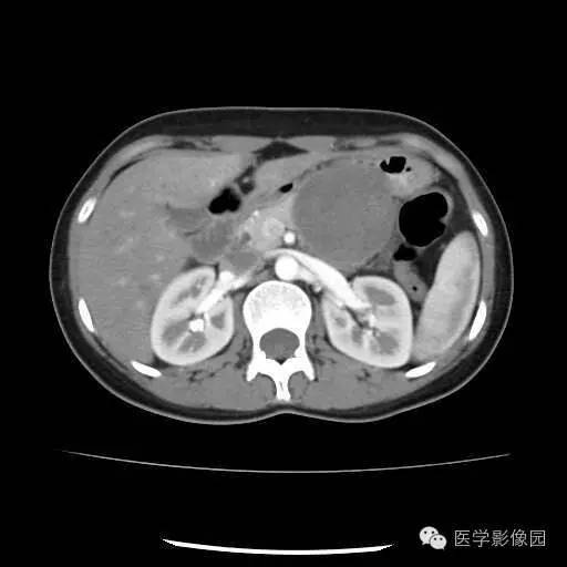 【病例】胰腺实性假乳头状瘤1例CT影像表现 【病例】胰腺实性假乳头状瘤1例CT影像表现