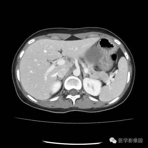 【病例】胰腺实性假乳头状瘤1例CT影像表现 【病例】胰腺实性假乳头状瘤1例CT影像表现