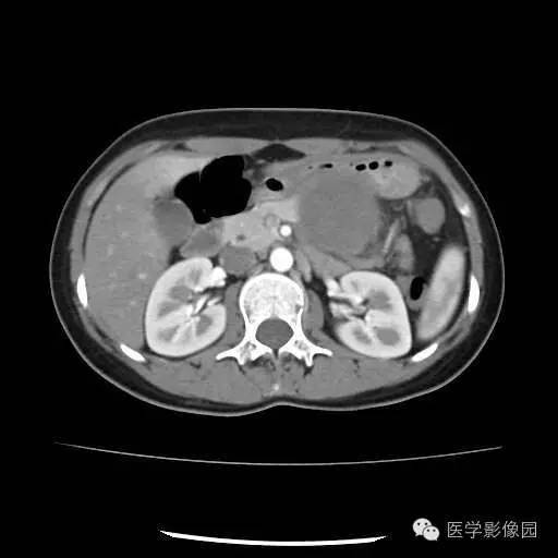 【病例】胰腺实性假乳头状瘤1例CT影像表现 【病例】胰腺实性假乳头状瘤1例CT影像表现