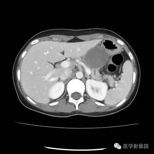 【病例】胰腺实性假乳头状瘤1例CT影像表现 【病例】胰腺实性假乳头状瘤1例CT影像表现