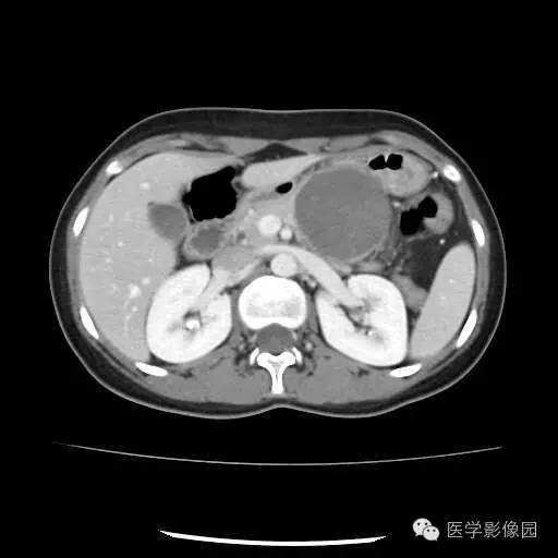 【病例】胰腺实性假乳头状瘤1例CT影像表现 【病例】胰腺实性假乳头状瘤1例CT影像表现