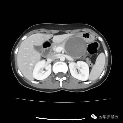 【病例】胰腺实性假乳头状瘤1例CT影像表现 【病例】胰腺实性假乳头状瘤1例CT影像表现