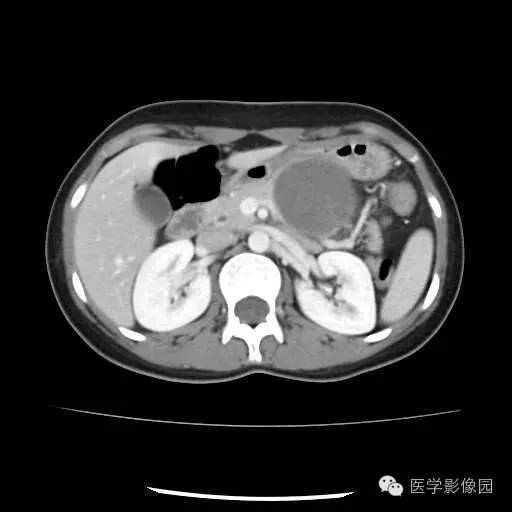 【病例】胰腺实性假乳头状瘤1例CT影像表现 【病例】胰腺实性假乳头状瘤1例CT影像表现