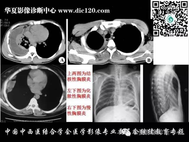 【PPT】胸壁常见病变影像诊断
