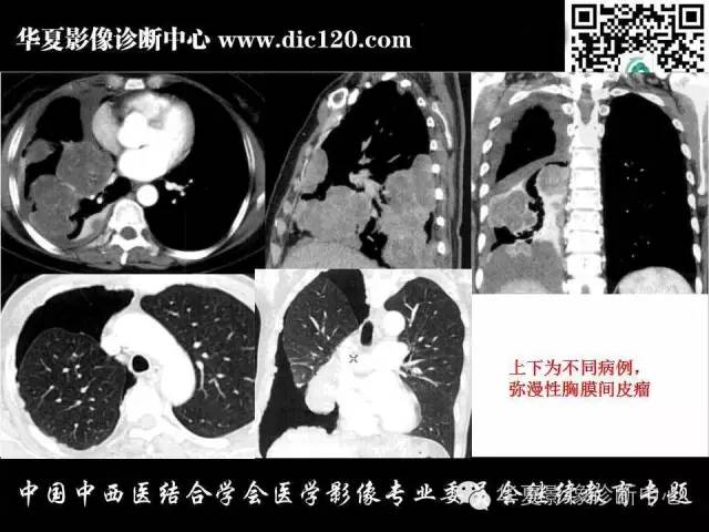 【PPT】胸壁常见病变影像诊断