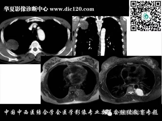 【PPT】胸壁常见病变影像诊断