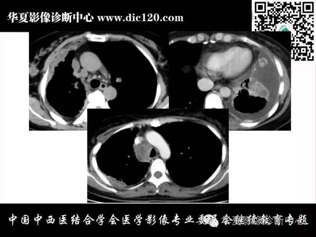 【PPT】胸壁常见病变影像诊断