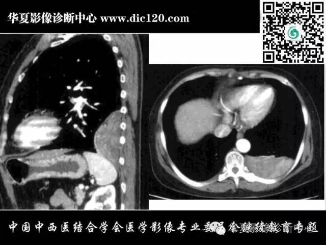 【PPT】胸壁常见病变影像诊断