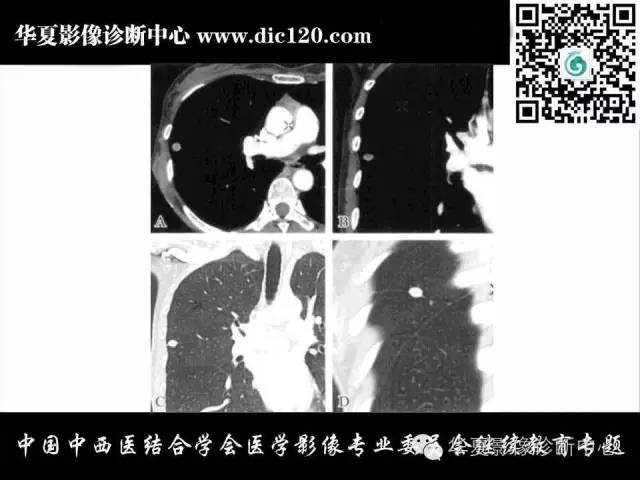 【PPT】胸壁常见病变影像诊断