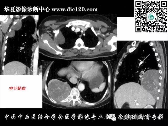 【PPT】胸壁常见病变影像诊断