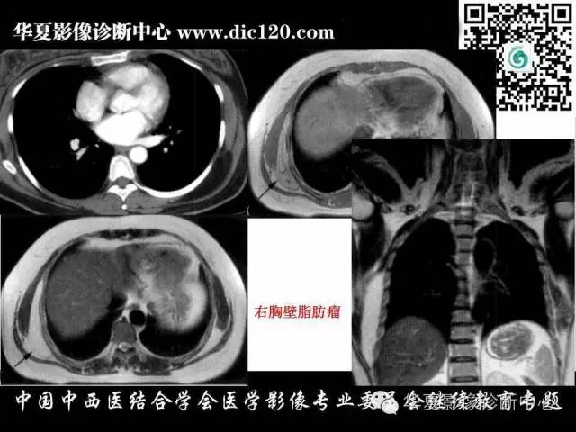 【PPT】胸壁常见病变影像诊断