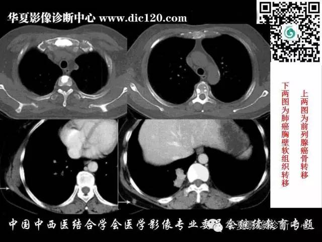 【PPT】胸壁常见病变影像诊断
