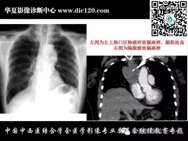 【PPT】胸壁常见病变影像诊断