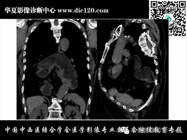 【PPT】胸壁常见病变影像诊断