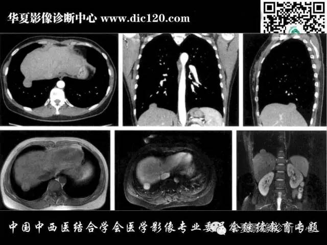 【PPT】胸壁常见病变影像诊断