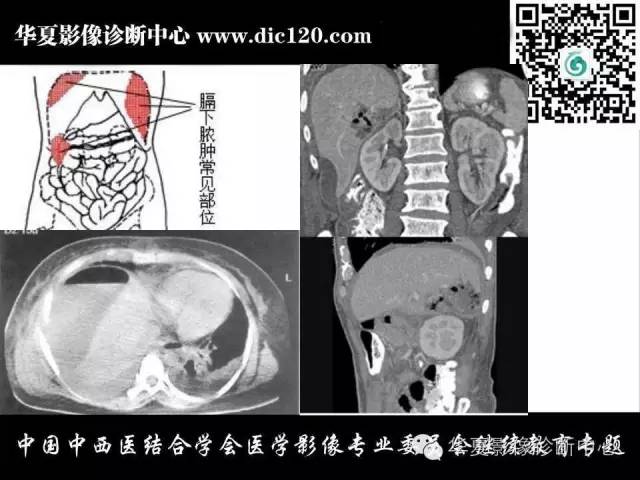 【PPT】胸壁常见病变影像诊断