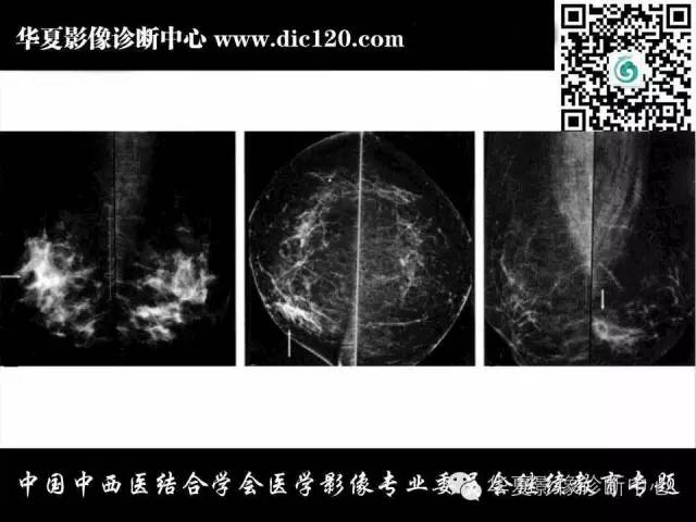 【PPT】胸壁常见病变影像诊断