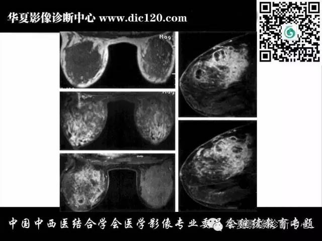 【PPT】胸壁常见病变影像诊断