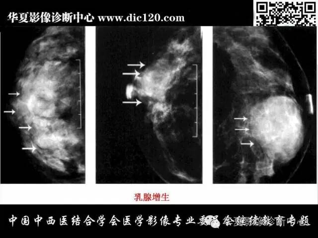【PPT】胸壁常见病变影像诊断