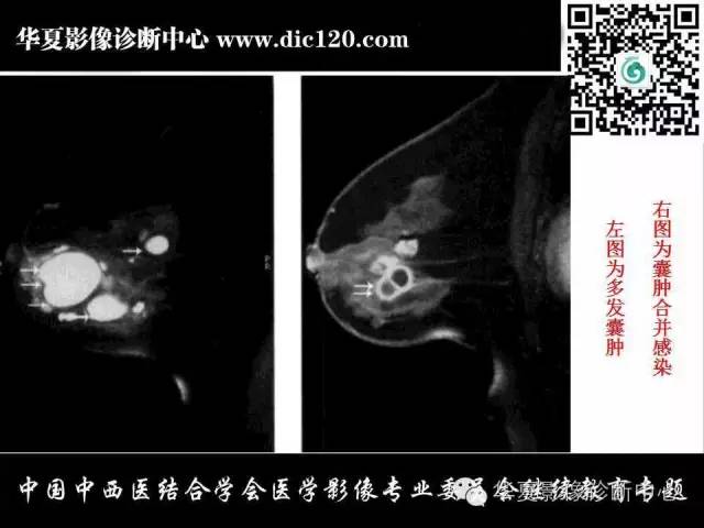 【PPT】胸壁常见病变影像诊断