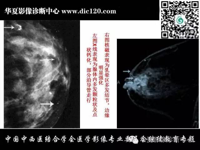 【PPT】胸壁常见病变影像诊断