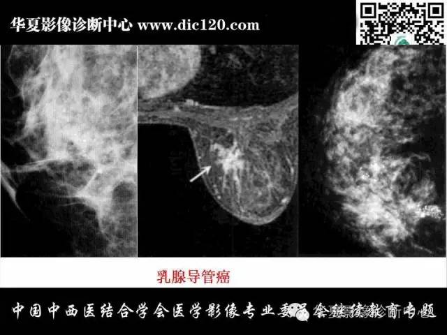 【PPT】胸壁常见病变影像诊断