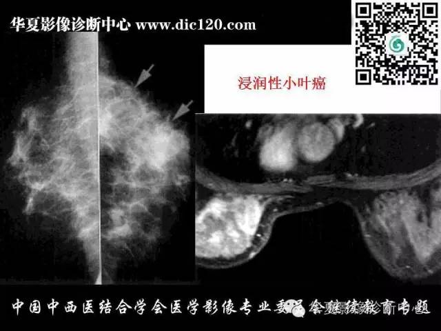 【PPT】胸壁常见病变影像诊断