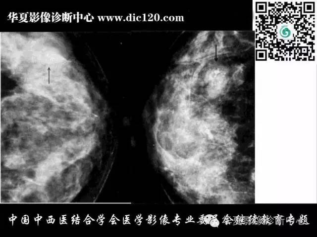 【PPT】胸壁常见病变影像诊断