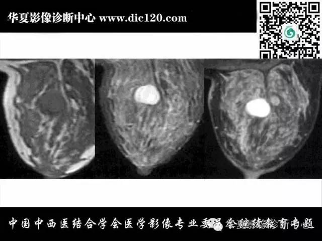 【PPT】胸壁常见病变影像诊断
