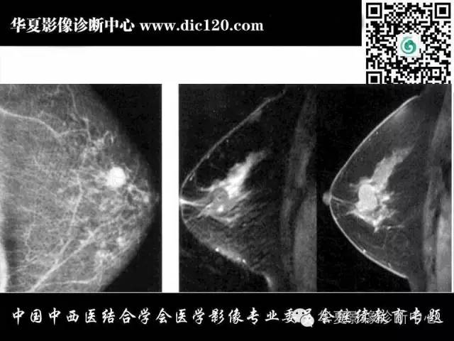 【PPT】胸壁常见病变影像诊断