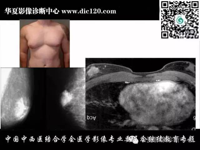 【PPT】胸壁常见病变影像诊断