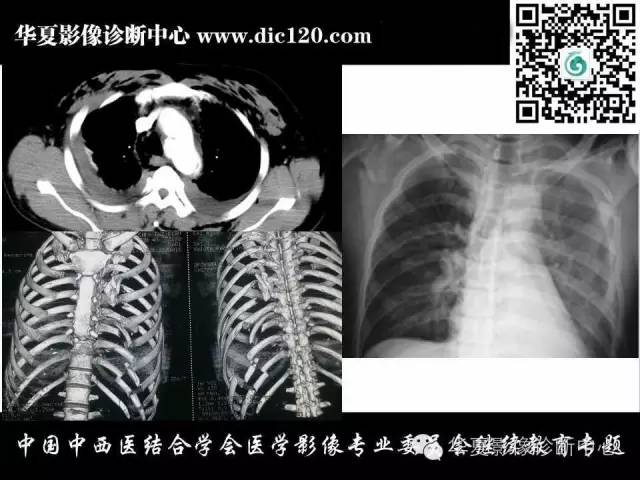 【PPT】胸壁常见病变影像诊断