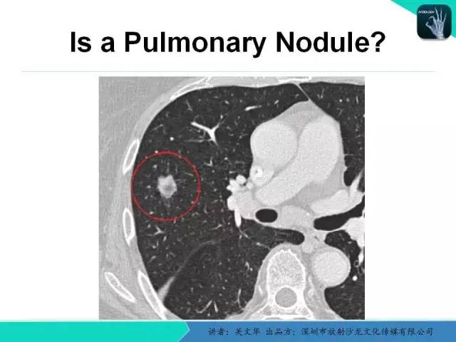 【PPT】孤立性肺结节的影像学诊断