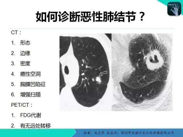 【PPT】孤立性肺结节的影像学诊断