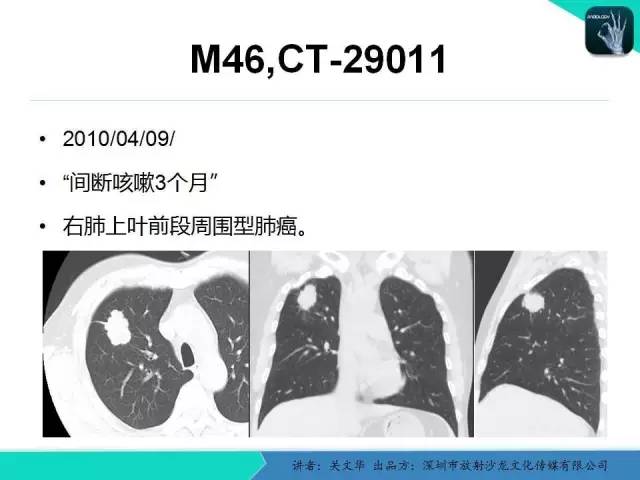 【PPT】孤立性肺结节的影像学诊断