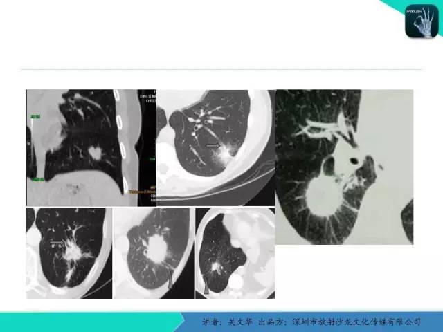 【PPT】孤立性肺结节的影像学诊断