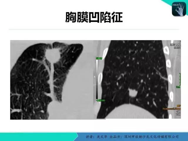 【PPT】孤立性肺结节的影像学诊断