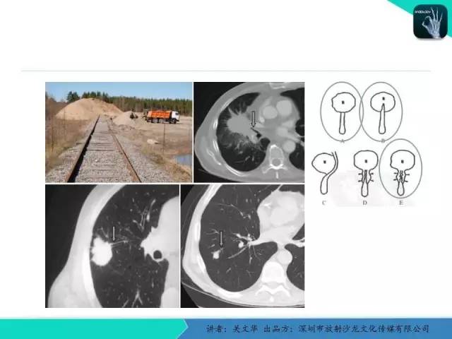 【PPT】孤立性肺结节的影像学诊断