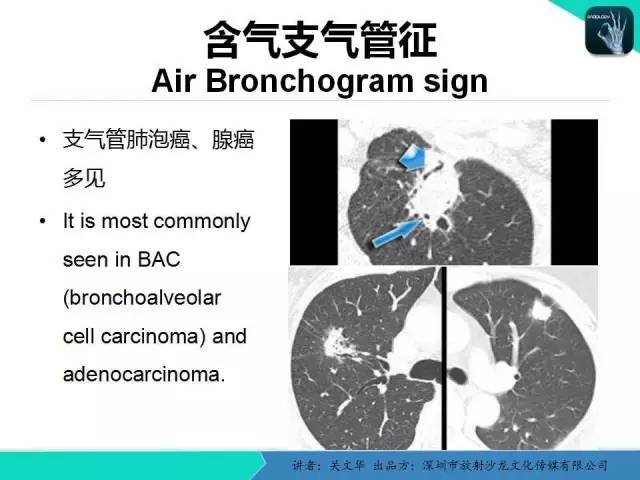 【PPT】孤立性肺结节的影像学诊断