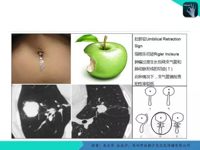 【PPT】孤立性肺结节的影像学诊断