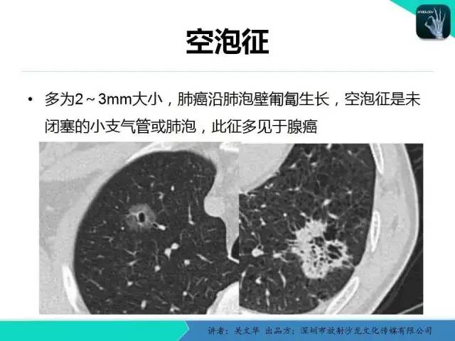 【PPT】孤立性肺结节的影像学诊断