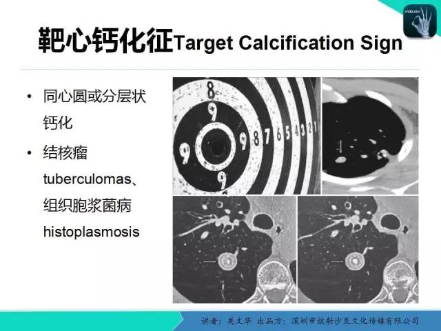 【PPT】孤立性肺结节的影像学诊断