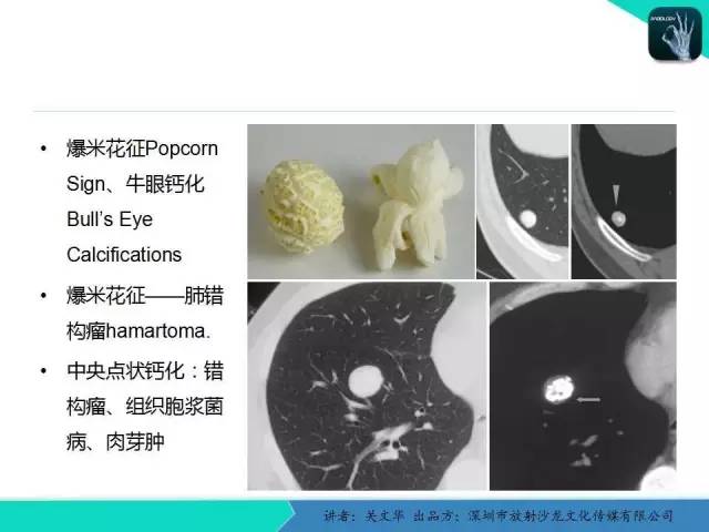 【PPT】孤立性肺结节的影像学诊断