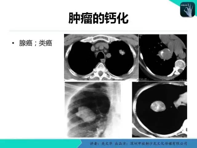 【PPT】孤立性肺结节的影像学诊断