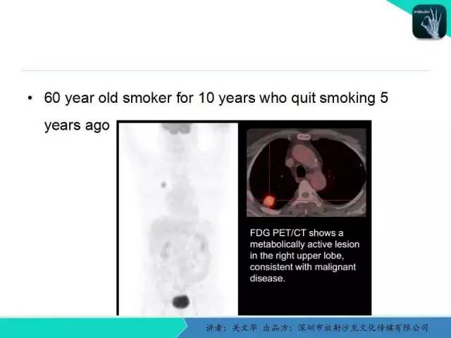 【PPT】孤立性肺结节的影像学诊断