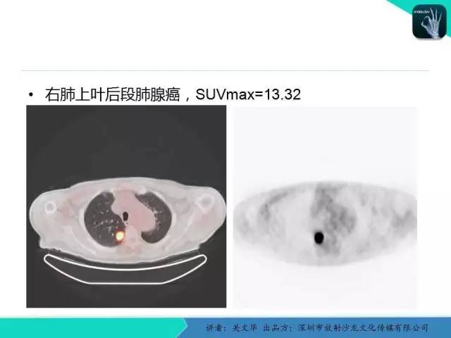 【PPT】孤立性肺结节的影像学诊断