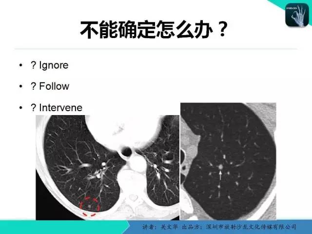 【PPT】孤立性肺结节的影像学诊断