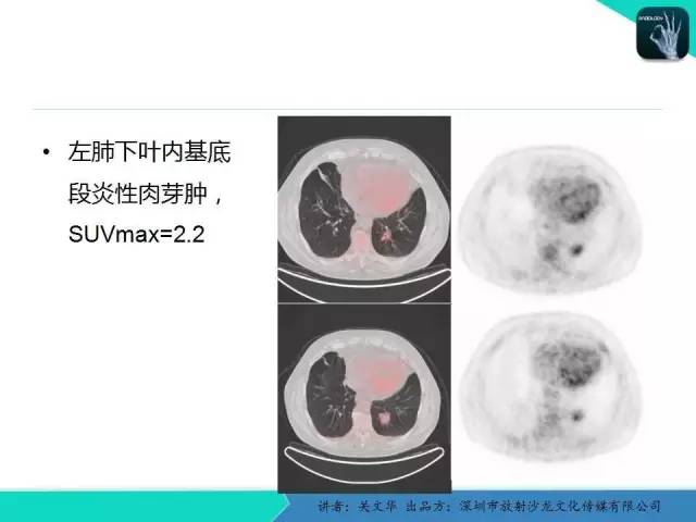 【PPT】孤立性肺结节的影像学诊断